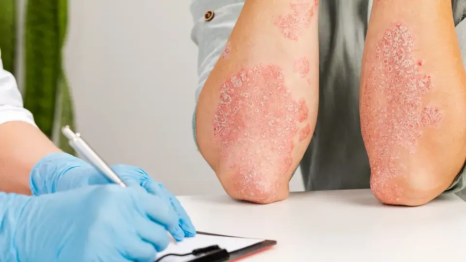 psoriasis