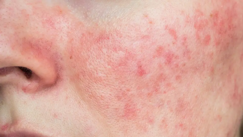 Rosacea Treatments