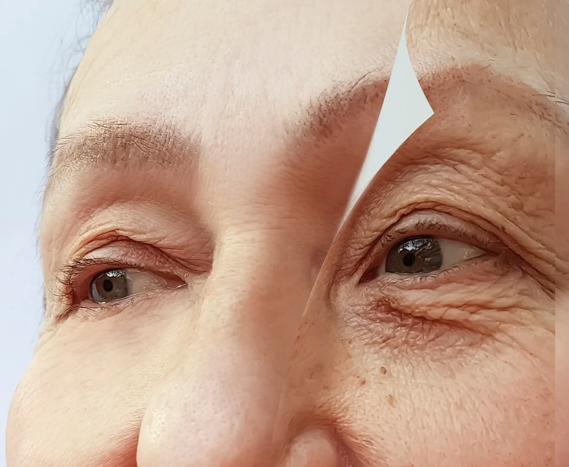 Fine Lines and Wrinkles Treatment